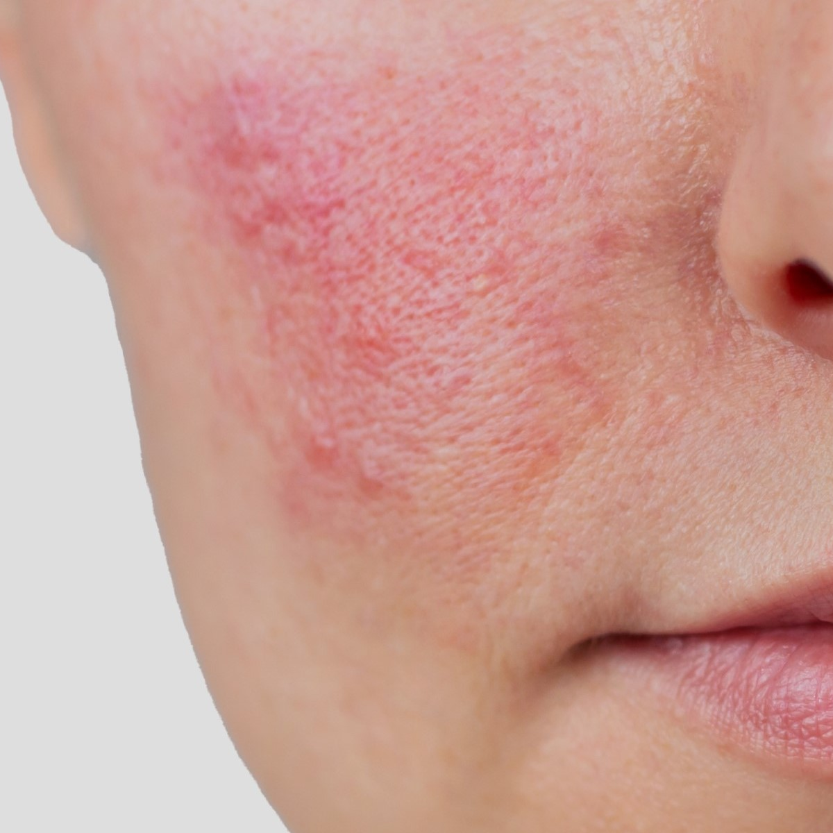 Пече, червоніє, стягує: як зрозуміти, що ви пошкодили захисний бар'єр шкіри, і як його відновити