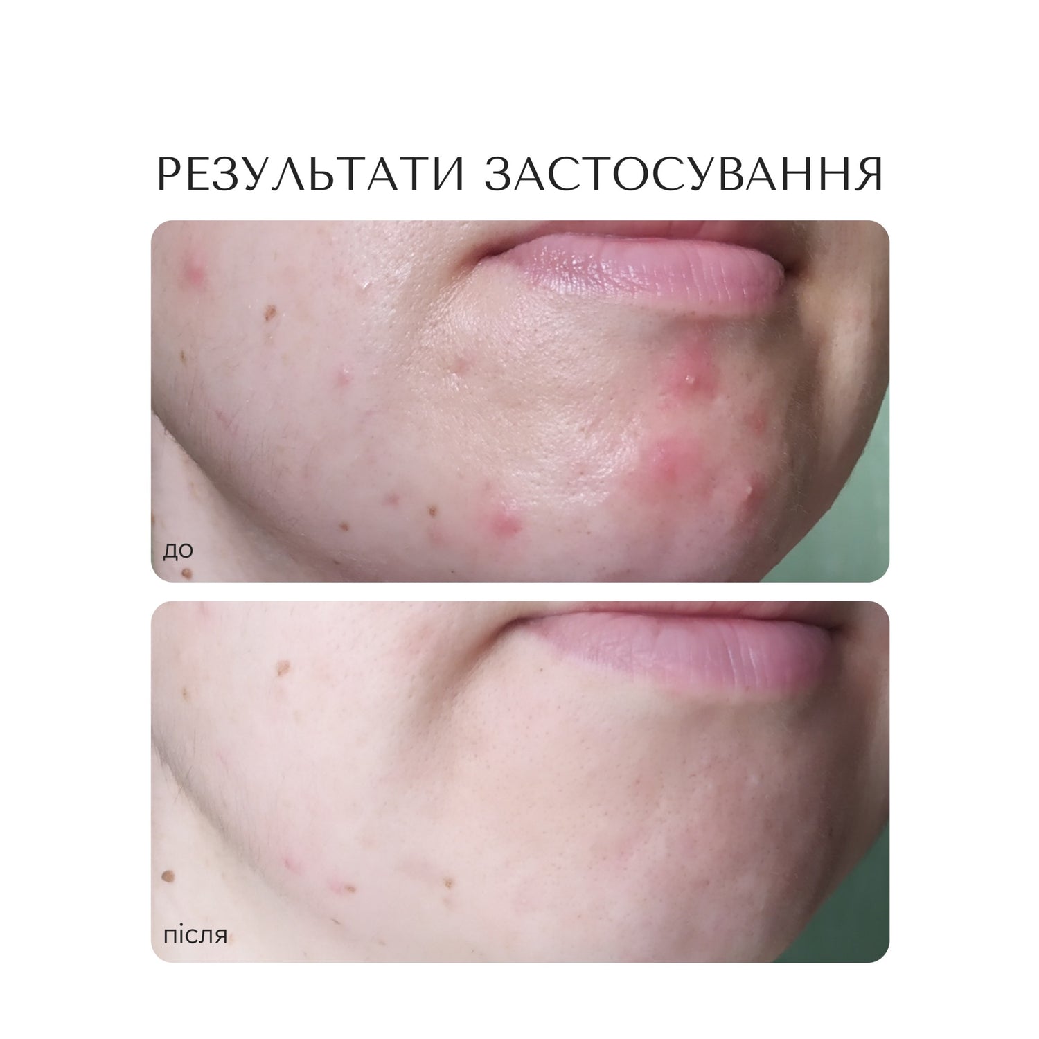 ПРОТИЗАПАЛЬНА СИРОВАТКА ДЛЯ ОБЛИЧЧЯ "PORE PURIFYING"