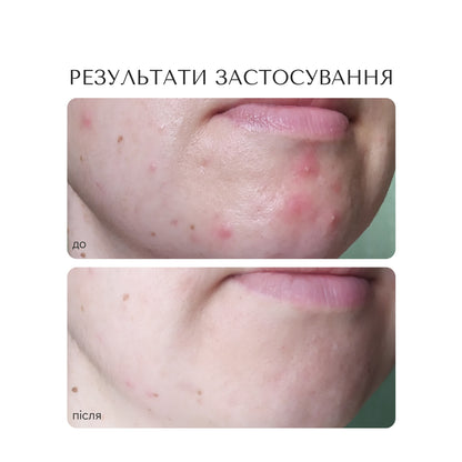 ПРОТИЗАПАЛЬНА СИРОВАТКА ДЛЯ ОБЛИЧЧЯ "PORE PURIFYING"